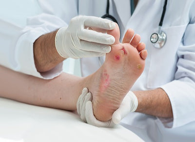 Diabetic Foot Ulcers: Prevention, Diagnostics, Treatment, and Tips